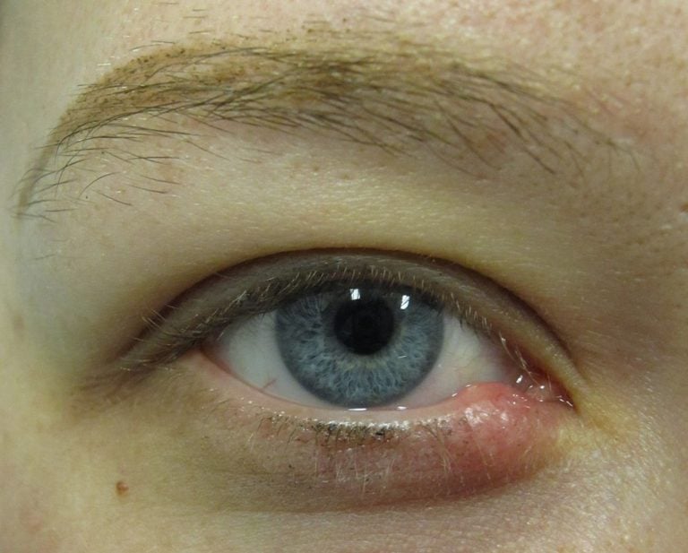 Stye Eye How Long Does a Stye last on your eye Daily Medicos