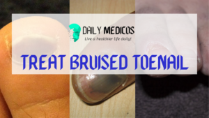 How to treat a bruised toenail
