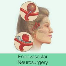 Scope Of Career In Endovascular Surgical Neuroradiology In Pakistan 2 Scope Of Career In Endovascular Surgical Neuroradiology In Pakistan 2 - Daily Medicos